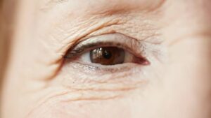 szemhéjkorrekció szemhéjplasztika műtéttel